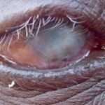 tracoma